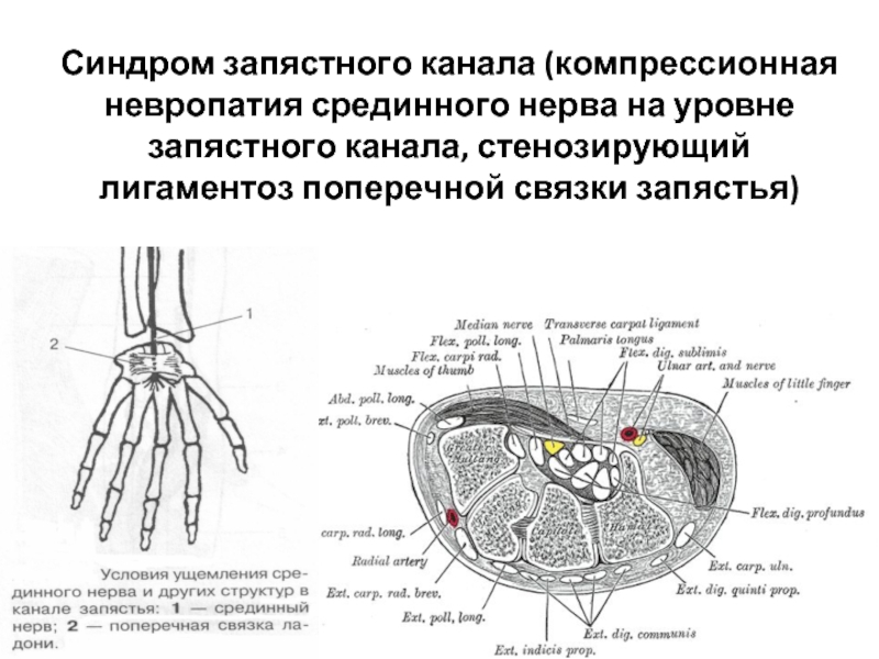 Срединный нерв запястья. Карпальный синдром на УЗИ лучезапястного сустава. Поперечная связка запястного канала. Каналы запястья топографическая анатомия. Карпальный канал лучезапястного сустава анатомия.