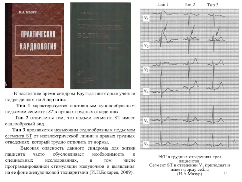 Синдром бругада презентация