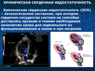 Хроническая сердечная недостаточность