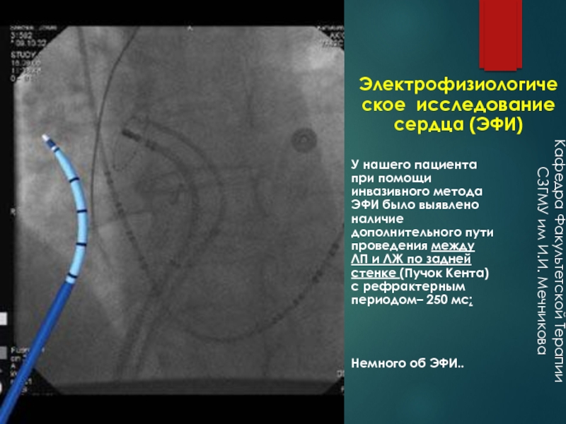 Эфи. Эфи метод исследования сердца. Эндокардиальное эфи сердца что это. Электрофизиологическое исследование сердца. Электрофизиологические методы исследования сердца.
