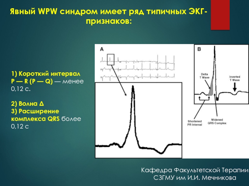 Wpw синдром на экг фото