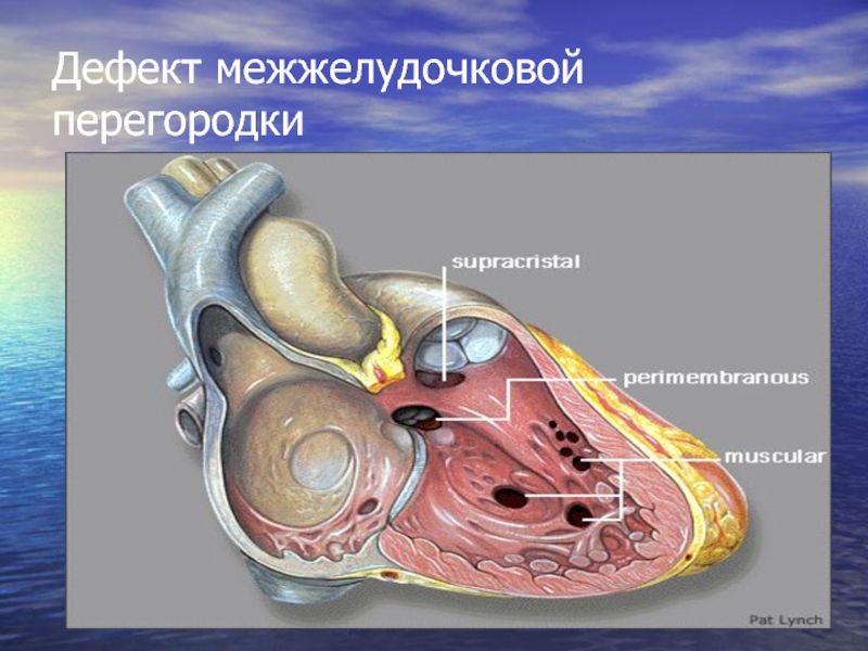 Дефект межжелудочковой перегородки картинки