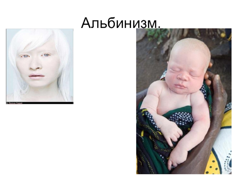 Альбинизмом страдают. Альбинизм у человека презентация.
