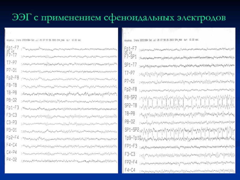 ЭЭГ. ЭЭГ показания. Электроды ЭЭГ. Заключение ЭЭГ.