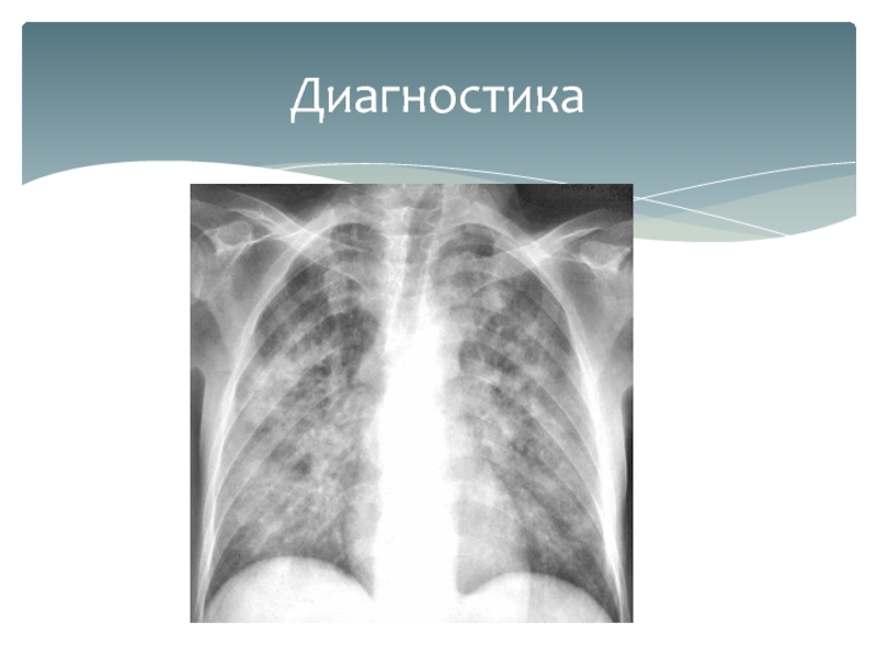 Пневмоцистоз. Пневмоцистная пневмония у ВИЧ рентген. Рентген картина при пневмоцистной пневмонии. Рентген легких при пневмоцистной пневмонии. Рентген при пневмоцистной пневмонии.