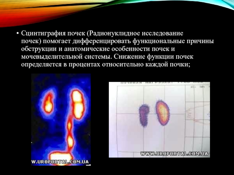 Гидронефроз презентация урология