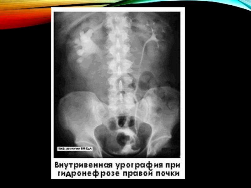 Гидронефроз у детей презентация