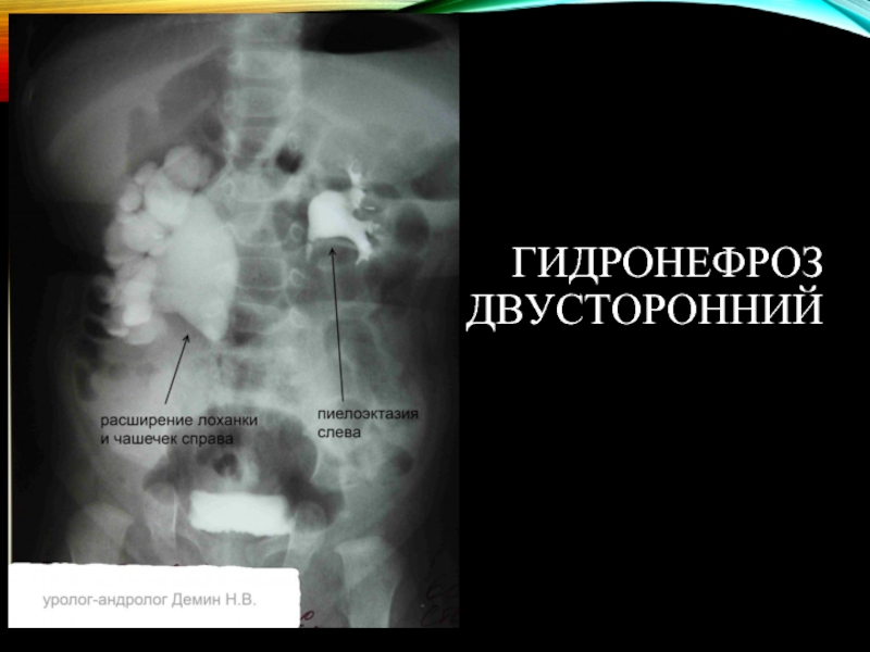 Гидронефроз у детей презентация