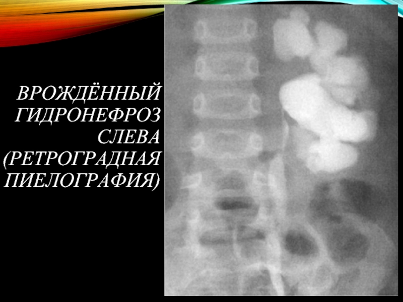 Гидронефроз презентация урология