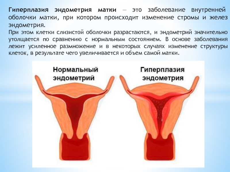 Увеличена эндометрия матки