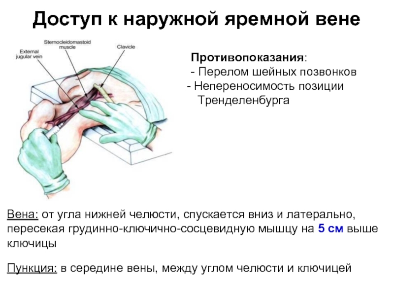 Катетеризация внутренней яремной вены схема