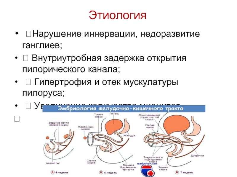 Пилоростеноз врожденный презентация