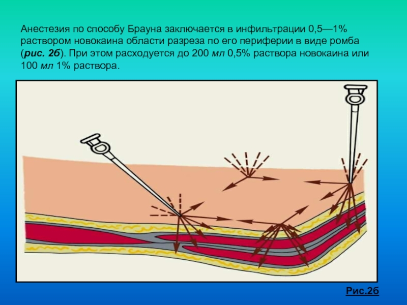 Анестезия по брауну