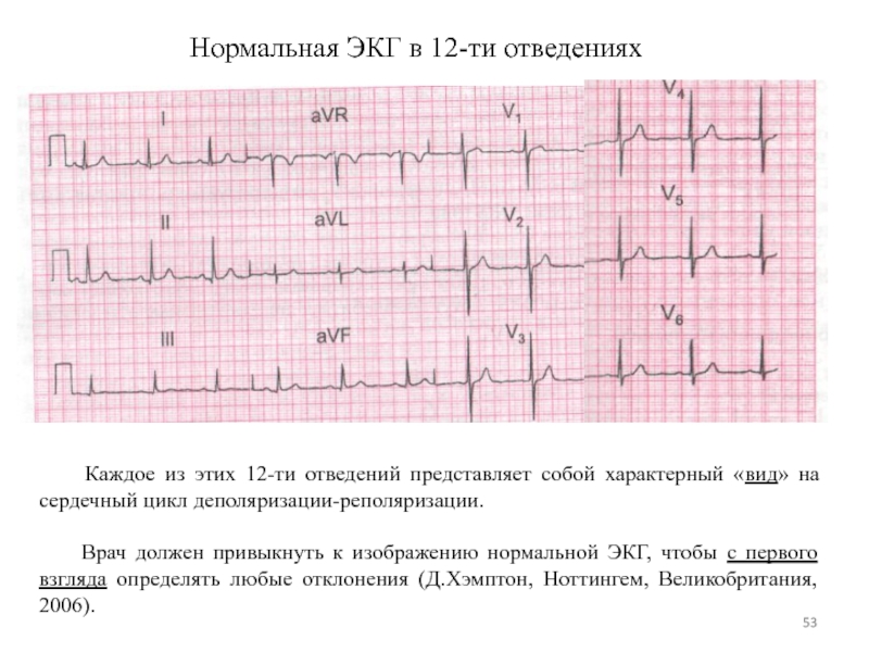 Норма экг фото во всех отведениях