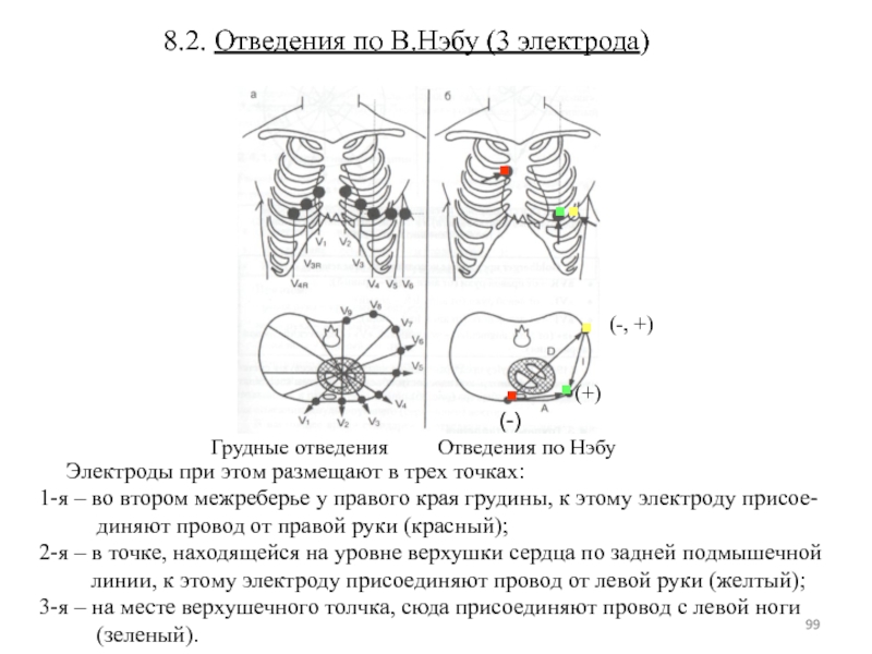 Правые отведения. Отведение v 6 активный электрод. Грудные отведения электроды. Отведения грудины. Электрод, накладывающийся в 4 межреберье у левого края грудины.