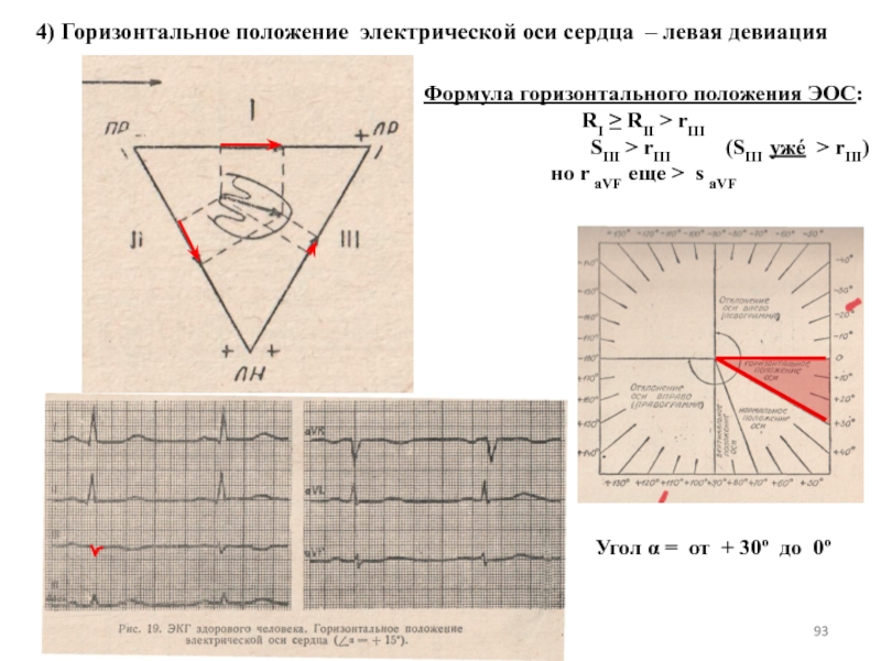 Положение 21. Горизонтальная электрическая ось сердца на ЭКГ. ЭОС горизонтальная на ЭКГ У взрослого. Горизонтальная ЭОС сердца на ЭКГ. Горизонтальное положение ЭОС на ЭКГ.