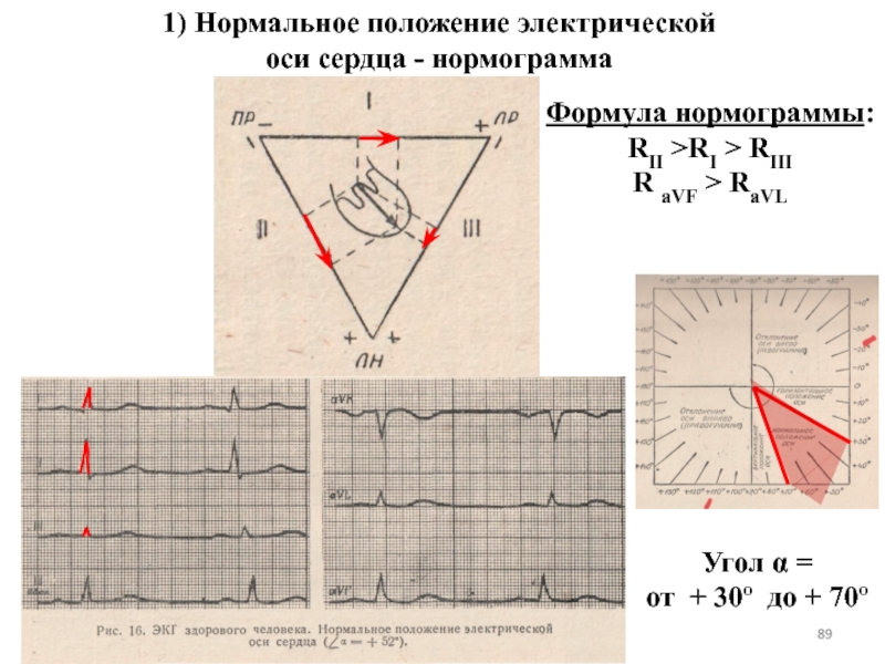 Горизонтальное экг. Нормальная электрическая ось сердца на ЭКГ. Нормальное положение электрической оси сердца. Нормальное положение электрической оси на ЭКГ. ЭОС В норме на ЭКГ.