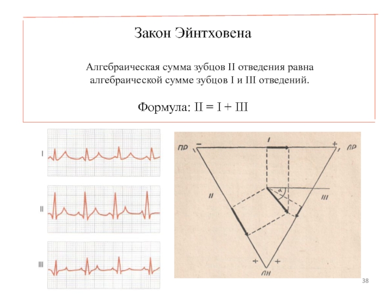 Эйнтховен экг