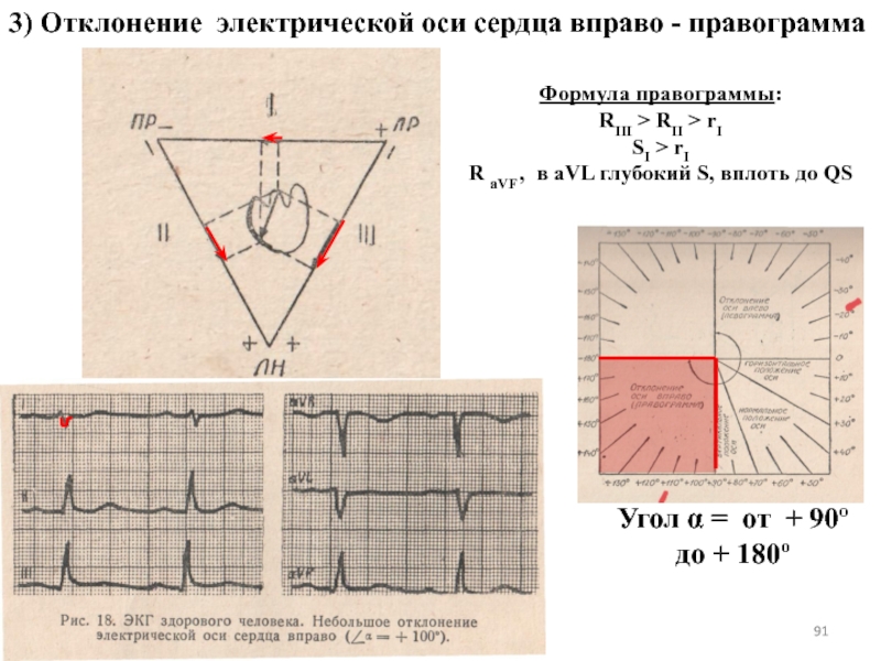 Отклонения оси. Отклонение Эл оси вправо ЭКГ. ЭОС отклонена вправо на ЭКГ. Отклонение оси на ЭКГ. Электрическая ось вправо на ЭКГ.