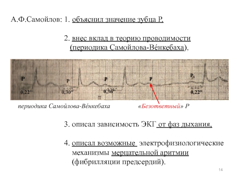 Экг это просто. Периодика Самойлова Венкебаха АВ блокада. 2х фазный зубец p на ЭКГ. АВ блокада 2 степени с периодикой Самойлова-Венкебаха. АВ блокада 2 степени Мобитц 1 с периодикой Самойлова Венкебаха.