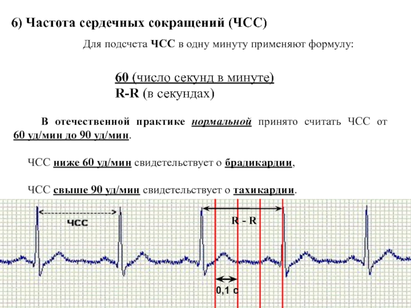 Как посчитать чсс на экг по клеточкам