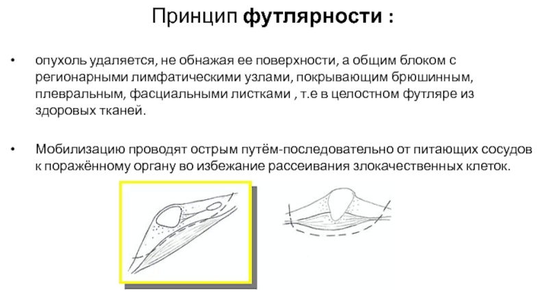 Абластика и антибластика в онкологии. Принцип футлярности. Принцип футлярности в онкологии. Принцип футлярности при удалении опухоли. Принцип футлярности и зональности.