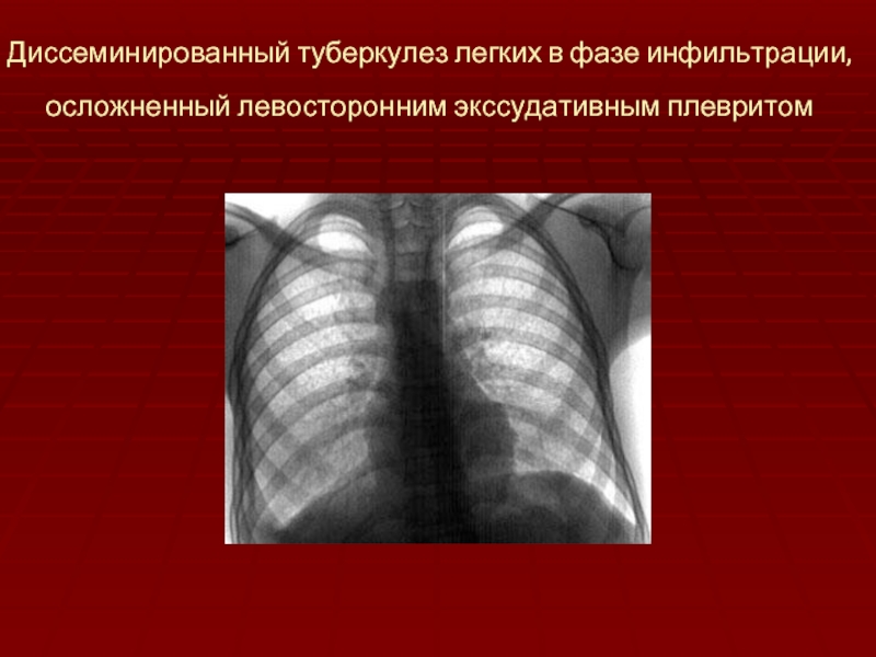 Острый диссеминированный туберкулез