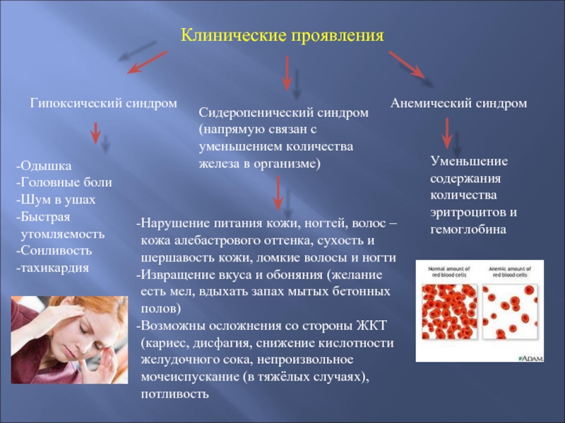 Клиническая патология. Сидеропенический синдром клинические проявления. Клинические симптомы анемического синдрома. Анемический синдром проявления. Сидеропеническая анемия.