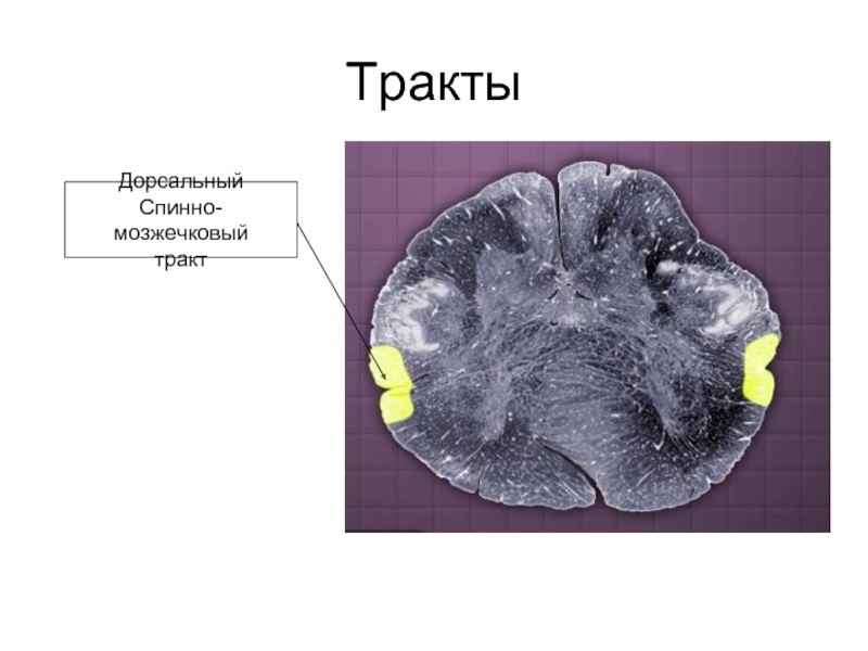 Дорсальный спинно-мозжечковый тракт. Мозжечковые тракты. Пино мозжечковый тракт. Атрофия продолговатого мозга.