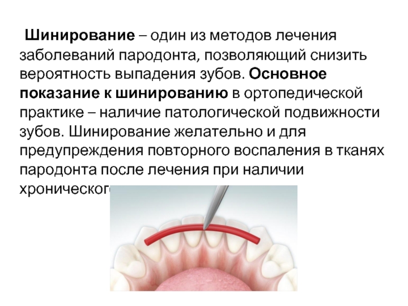 Профилактика заболеваний пародонта. Шинирование ортопедическая стоматология. Временное шинирование при заболеваниях пародонта. Комплексная терапия заболеваний пародонта. Шинирование зубов при подвижности.