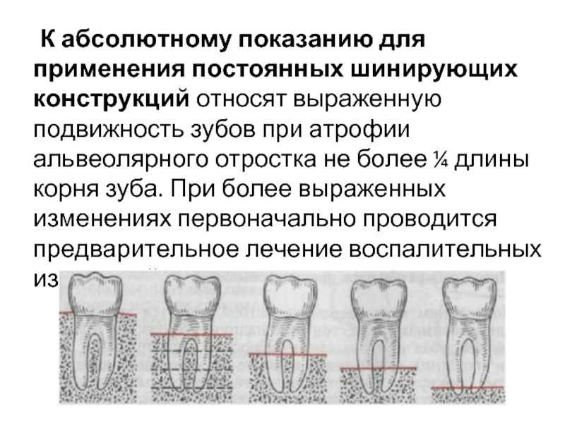 Подвижность зубов презентация