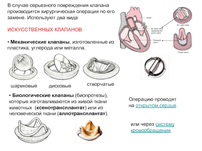 Срок службы сердца. Биологический протез аортального клапана. Биологические искусственные клапаны сердца. Механический протез аортального клапана. Аортальный биологический клапан сердца.