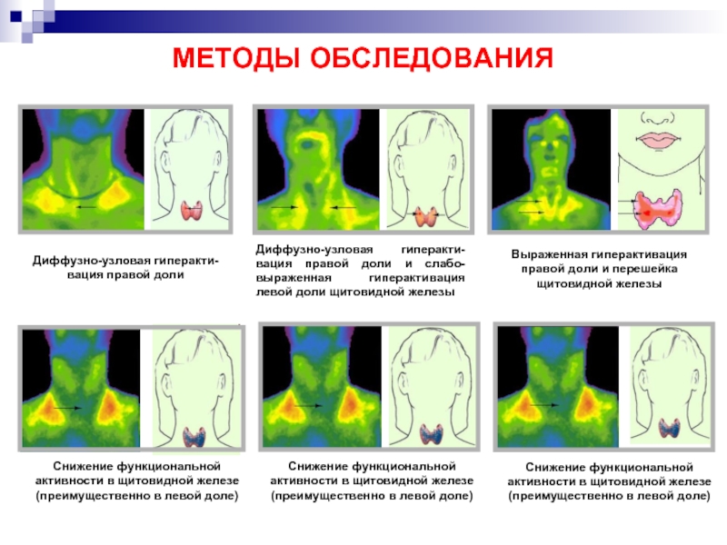 Щитовидная железа патофизиология презентация