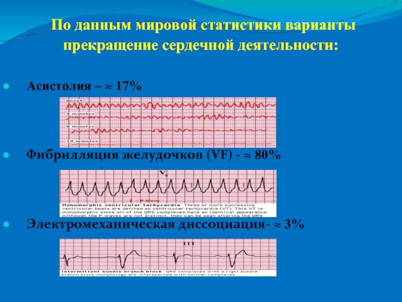 Асистолия на экг фото