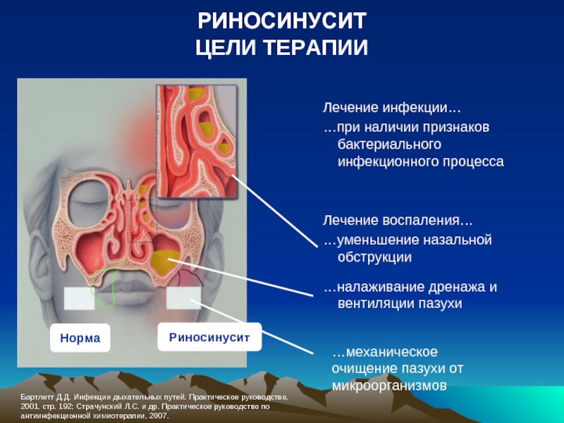 Острые и хронические синуситы презентация