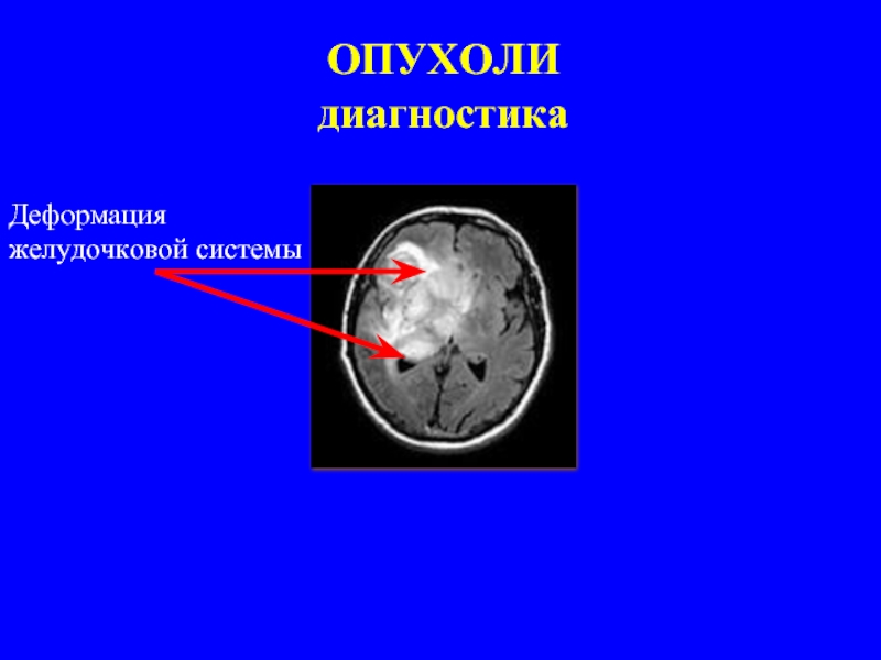 Мкб 10 объемное образование мозга. Перифокальный отек головного мозга на кт. Инфильтративное образование головного мозга. Объемное образование головного мозга диагностика. Перифокальная реакция мрт перифокальная головного мозга.