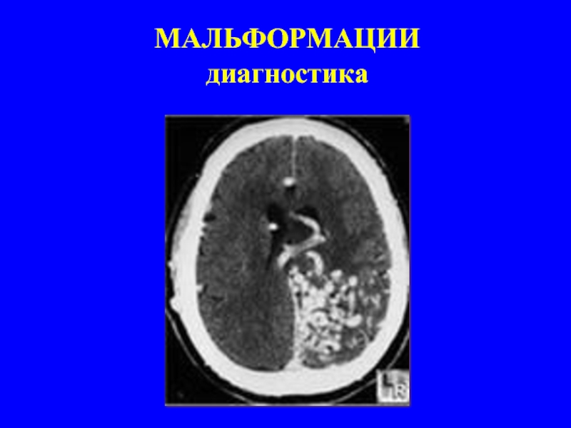 Объемное образование головного мозга мкб 10. Объемное образование головного мозга диагностика. Обызвествленные образования головного мозга.