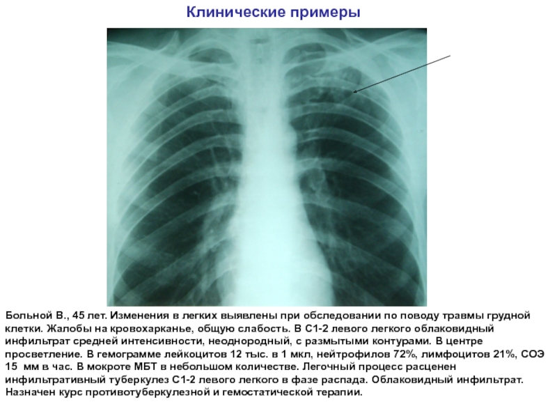 Функциональные изменения в легких. Облаковидный инфильтративный туберкулез рентген. Инфильтративный туберкулез легкого. Облаковидный инфильтрат.