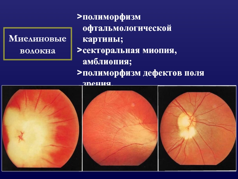 Дефекты сетчатки. Миелиновые нервные волокна глазное дно. Миелиновые волокна ДЗН. Миелиновые волокна диска зрительного нерва. Врожденная аномалия диска зрительного нерва миелиновые волокна.