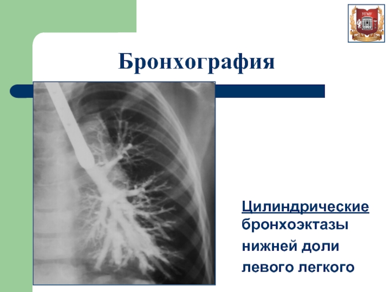 Бронхоэктатическая болезнь картинки