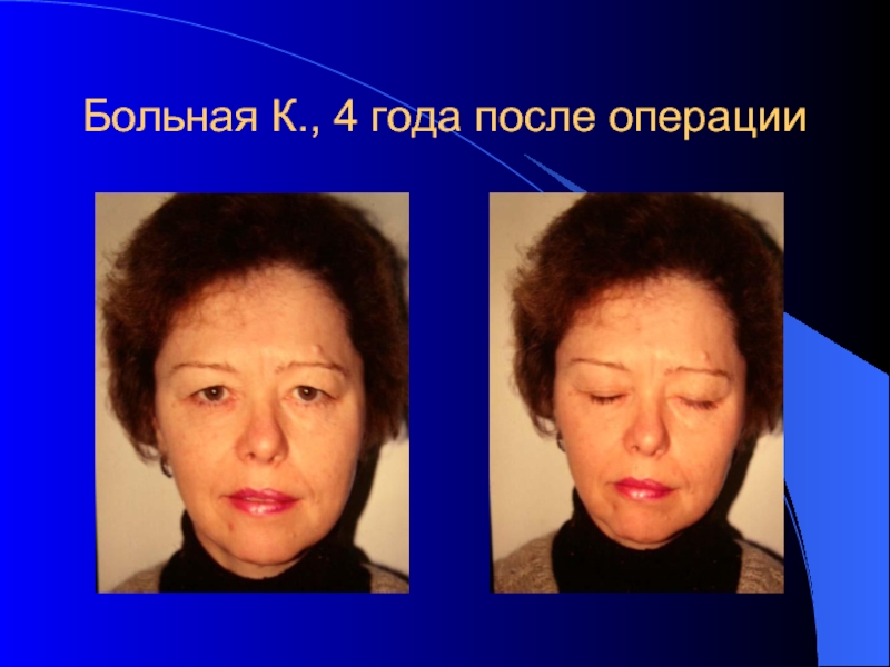 Лицевой нерв удаление. Парез лица после операции. Кросс пластика лицевого нерва. Восстановление лицевого нерва после операции невринома.
