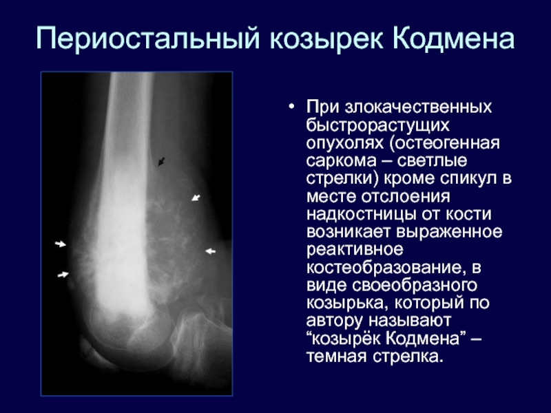 Патологическим костеобразованием напоминающим картину саркомы осложняется