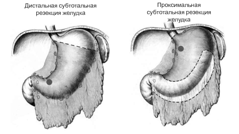 Резекция желудка картинки