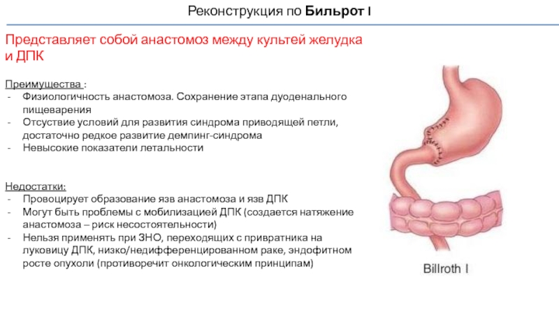 Бильрот 1 и бильрот 2 схема