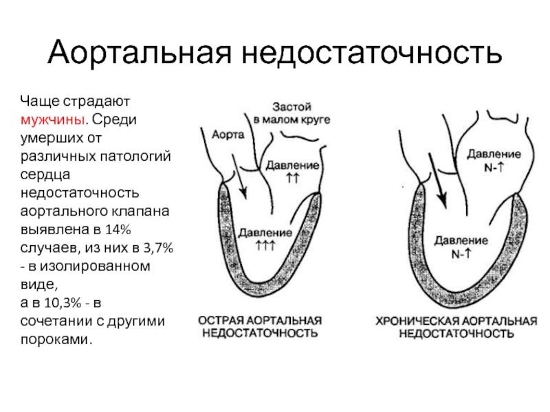 Аортальная недостаточность презентация