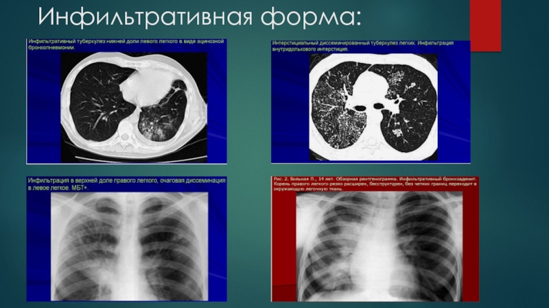 Реферат: Современная лучевая диагностика туберкулёза