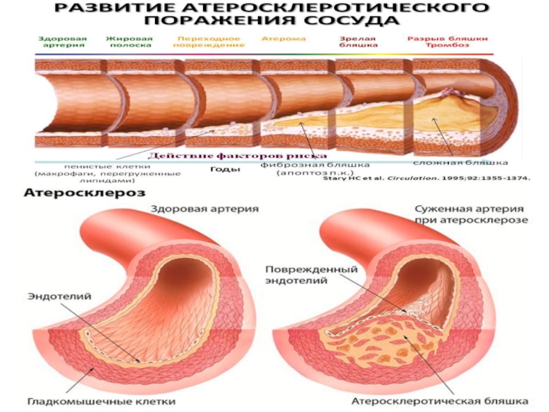 Атеросклероз что это