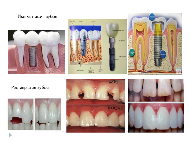 -Имплантация зубов -Реставрация зубов