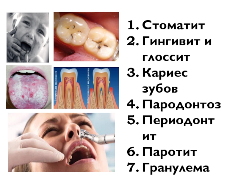 3 Стоматит Гингивит и глоссит Кариес зубов Пародонтоз  Периодонтит Паротит Гранулема зуба
