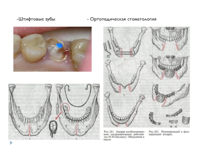 -Штифтовые зубы            - Ортопедическая стоматология